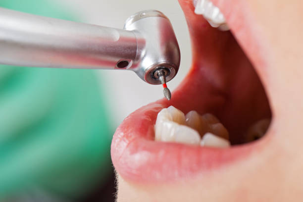 Best Knocked-Out Tooth (Avulsed Tooth) Treatment in USA